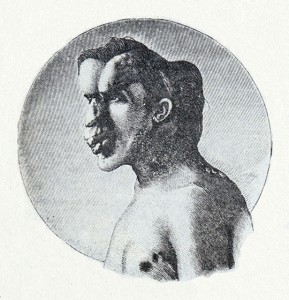 Image of Joseph Merrick published in the British Medical Journal in 1886